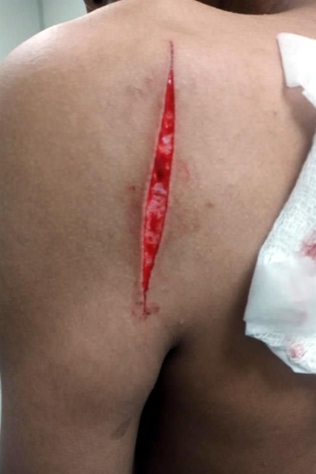 Mateo, de 12 años, requirió de 16 puntos de sutura para cerrarle la herida en la espalda.