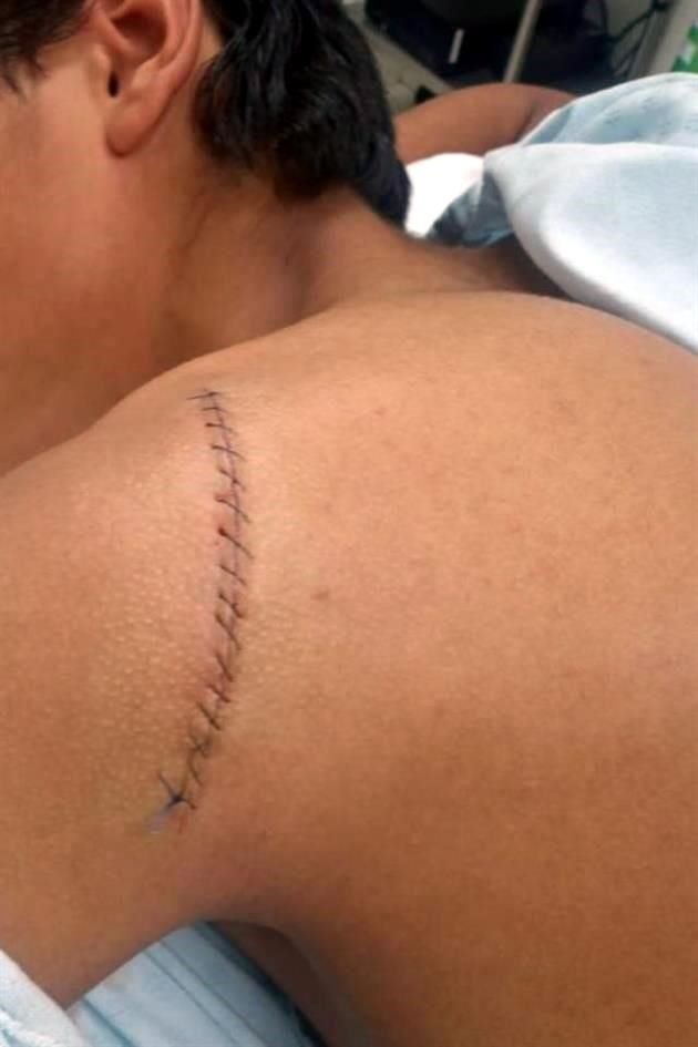 Mateo, de 12 años, requirió de 16 puntos de sutura para cerrarle la herida en la espalda.
