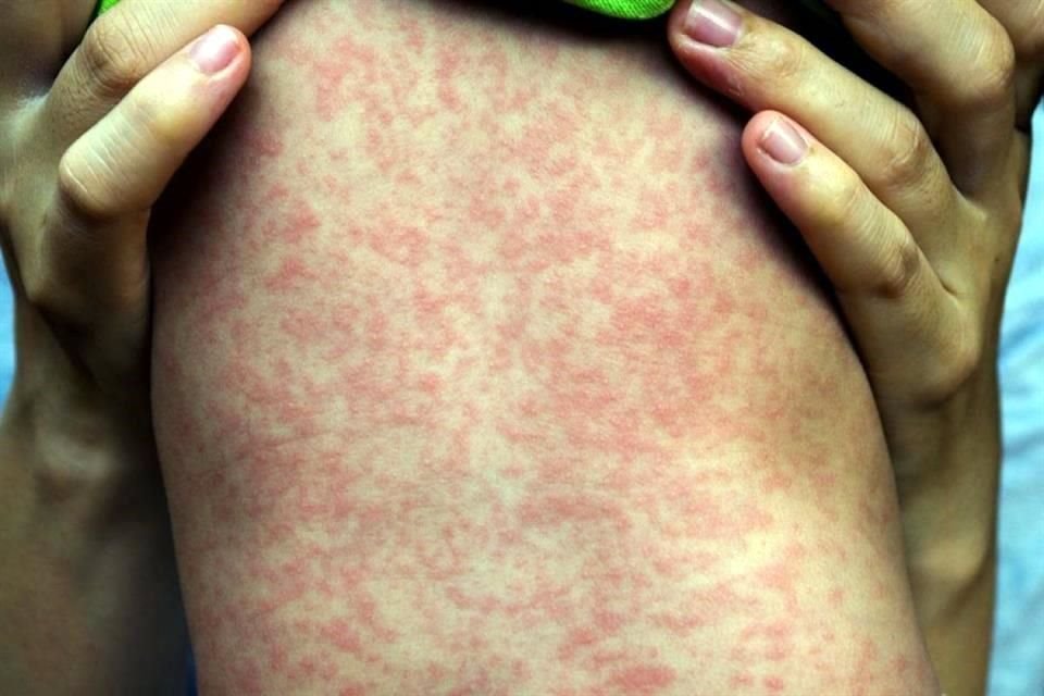 Con éste suman seis casos de sarampión importado detectados en el País en lo que va del año.