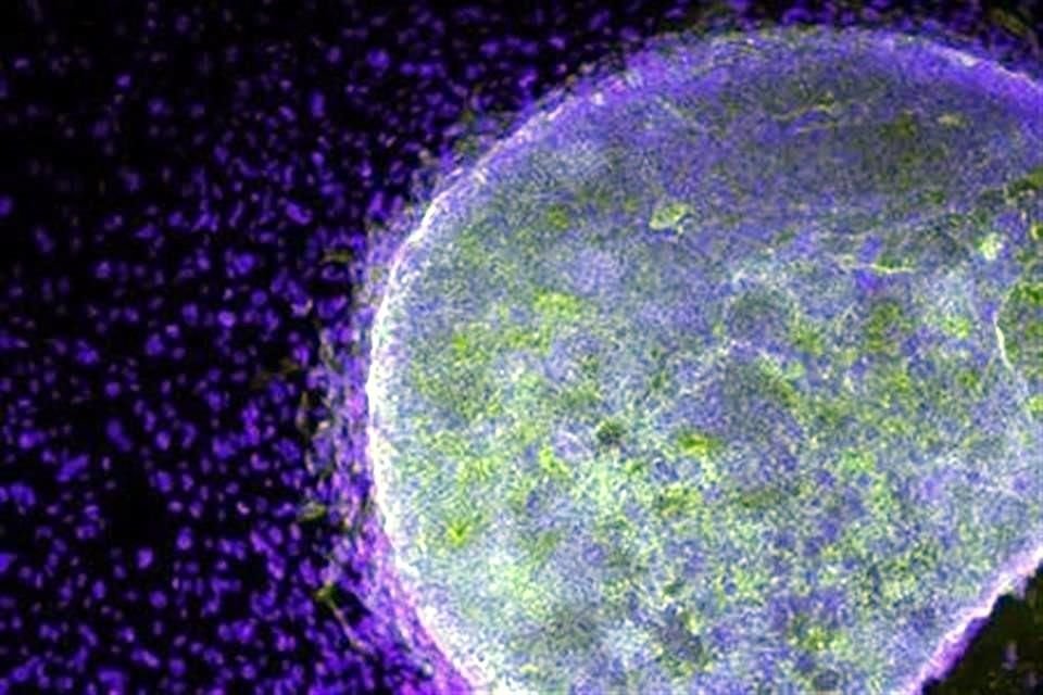 Los trasplantes de células madre generalmente son procedimientos severos que comienzan con radiación o quimio para dañar el sistema inmunológico existente en el cuerpo y dejar espacio para uno nuevo.
