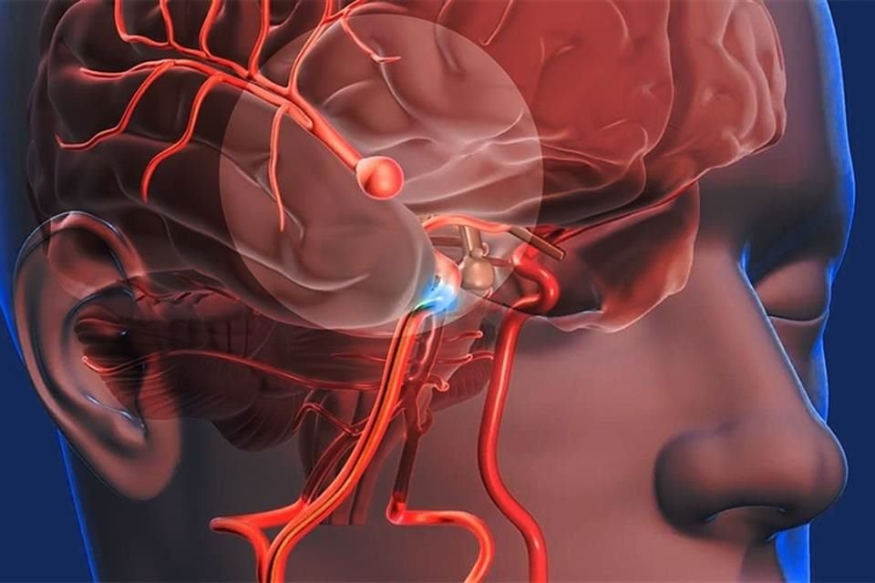 Un aneurisma es una protuberancia que se forma en la pared de un vaso sanguíneo, el cual impide una adecuada irrigación del cerebro; si crece demasiado, puede reventarse.
