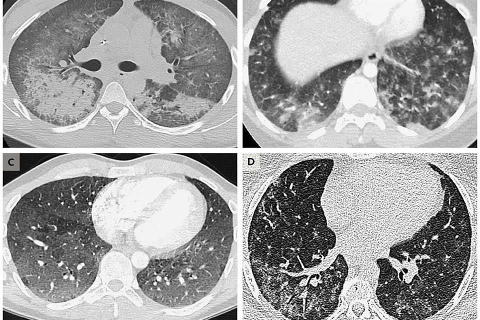 Radiografías muestran daños en los pulmones de cuatro pacientes, de entre 19 y 49 años de edad, ocasionados por el uso de vaporizadores.