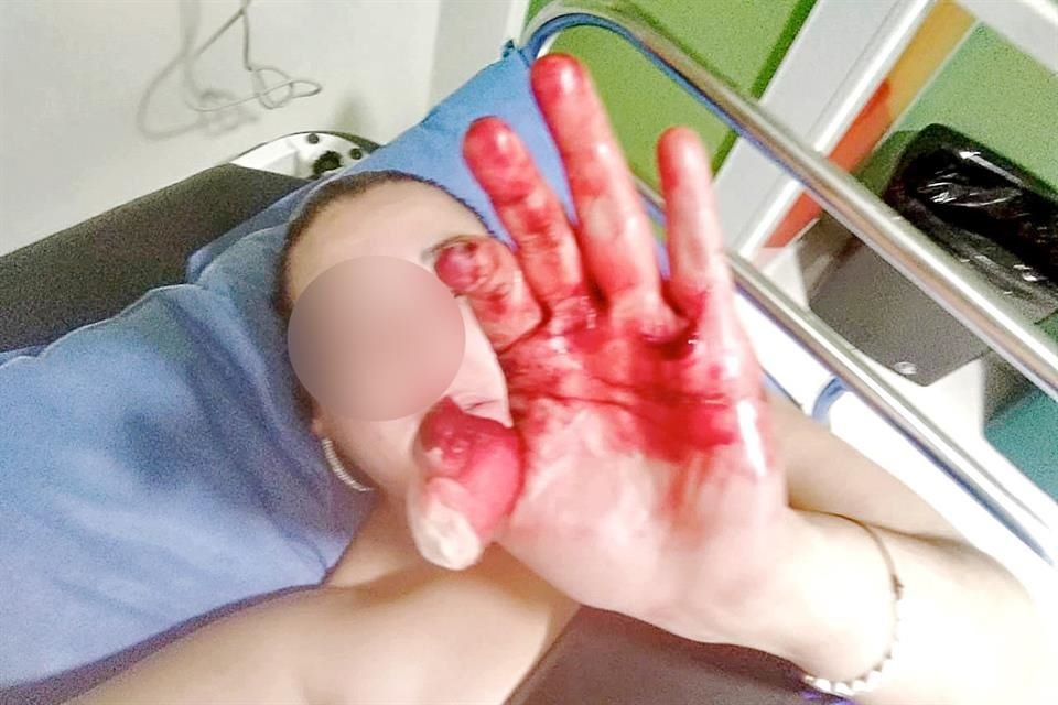 Italia Krystal González denunció que su esposo le amputó el dedo pulgar de la mano izquierda.