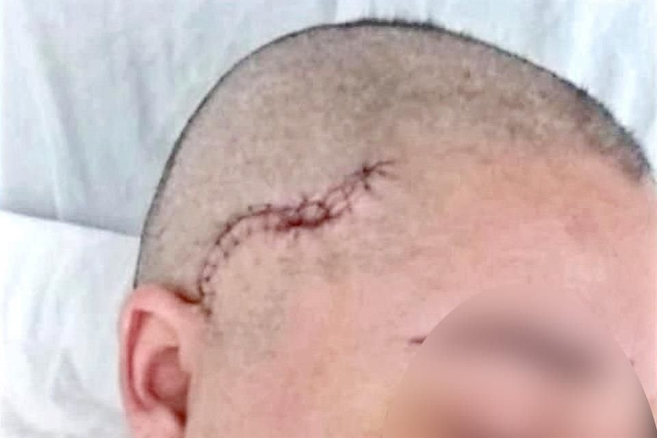 El año pasado le fracturó el cráneo.