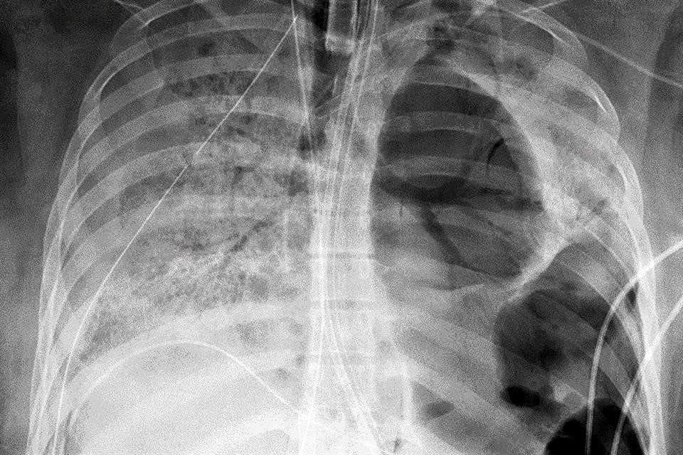 Las anteriores variantes del coronavirus afectaban más a los pulmones que Ómicron.