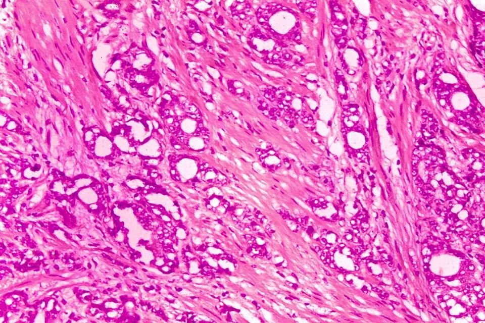 Imagen de microscopio que muestra cambios en las células que indican cáncer de próstata.