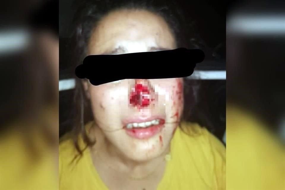 Al intentar abusar sexualmente de Jazmín, un ex candidato en Veracruz le arrancó parte de su nariz; desde un hospital, ella pide justicia.