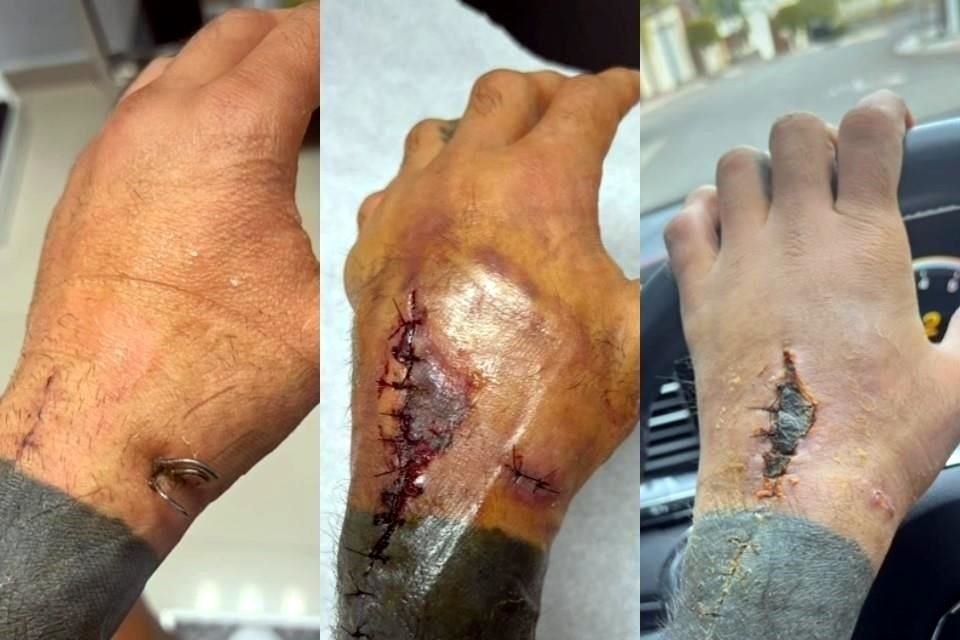 El ex portero de Rayados explicó el proceso por el que pasó para recuperarse después de dos cirugías en la muñeca izquierda y una infección.