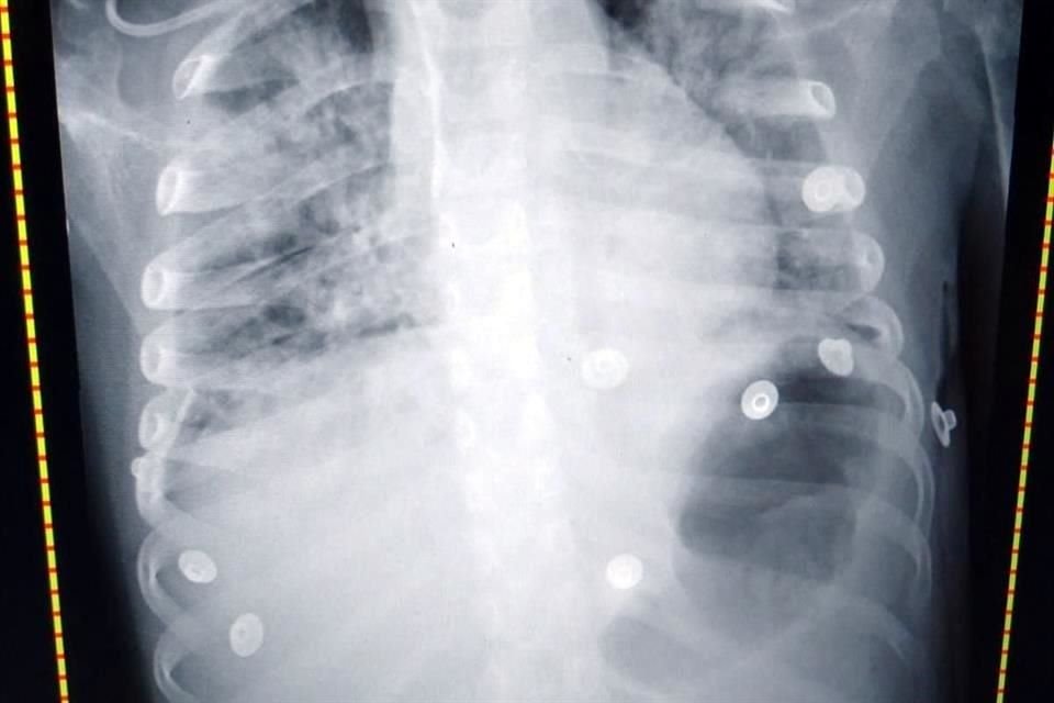 Asegurando tener autorización de familiares y cubriendo el rostro, el médico Mario Alberto Castillo publicó la foto de una niña que pasó cuatro días intubada, así como una radiografía.