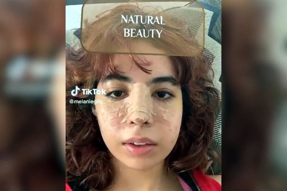 Melanie Gil subió a TikTok una imagen suya con la nariz recién operada.