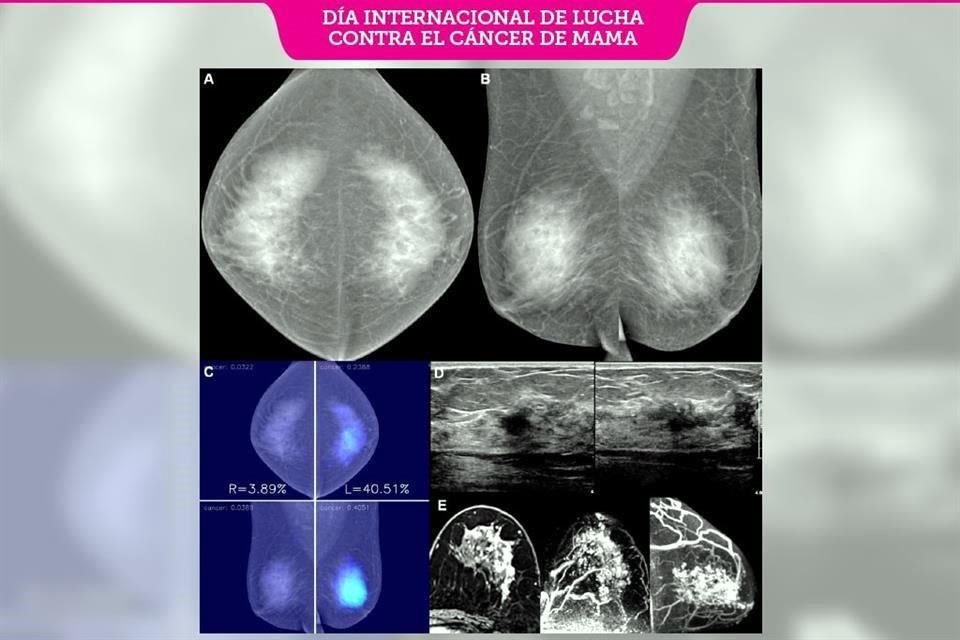 Imagen proporcionada por IA de porción de mama de una mujer de 50 años que brindó con precisión nivel de malignidad de cáncer.