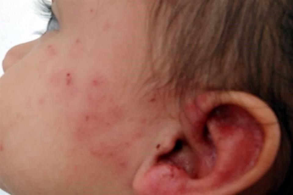 Los niños y los adultos mayores han sido los más perjudicados al presentarse infecciones en la piel.