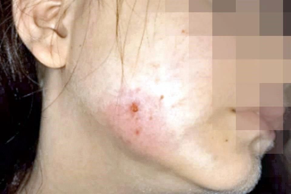 Los menores de edad tienen ronchas en todo el cuerpo.