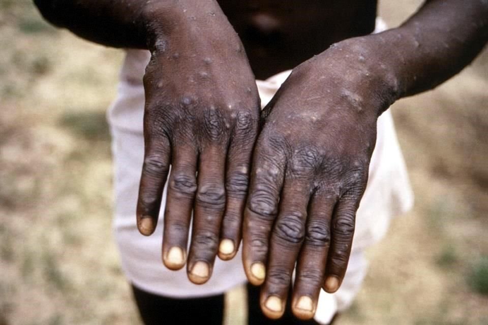 Esta imagen de 1997 muestra uno de los síntomas en un paciente enfermo de viruela del mono en la República Democrática del Congo.